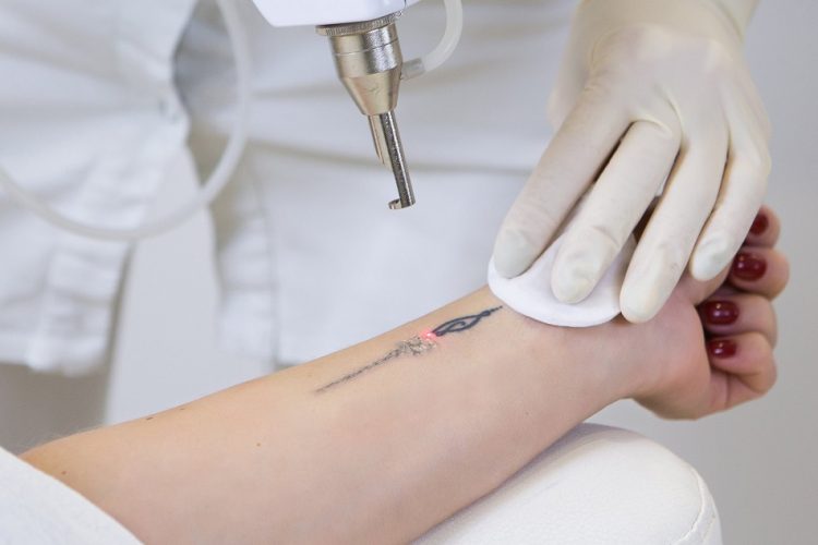 aesthetic device tattoo remove