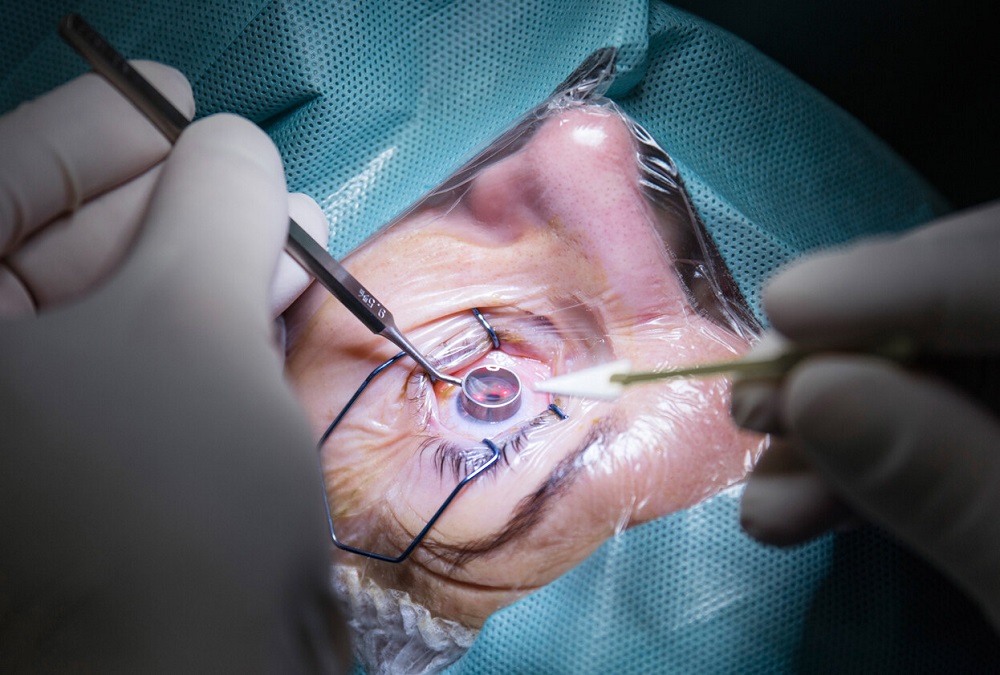 Vital Questions About LASIK Eye Surgery You Might Seek Answers To
