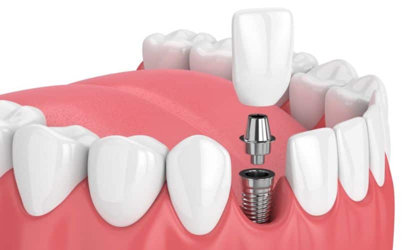 How Dental Implants Restore Function And Confidence